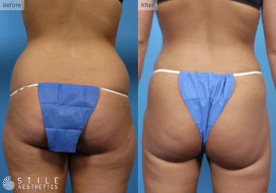 Liposuction Before & After Gallery - Patient 918132 - Image 1