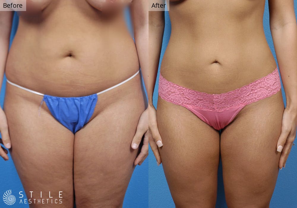 Liposuction Before & After Gallery - Patient 158058 - Image 1