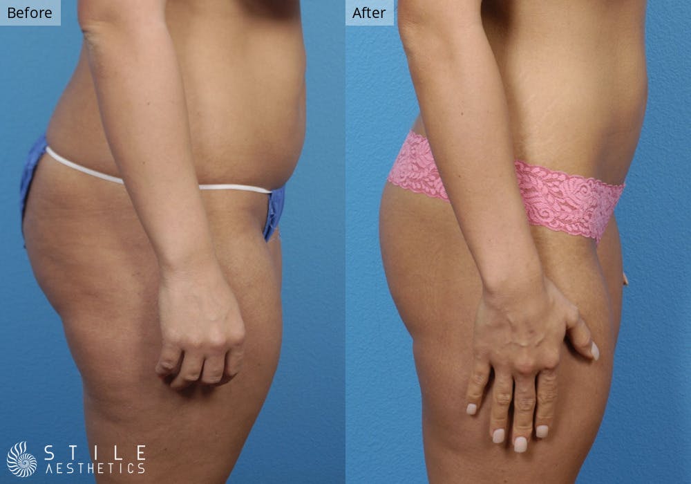 Liposuction Before & After Gallery - Patient 158058 - Image 2