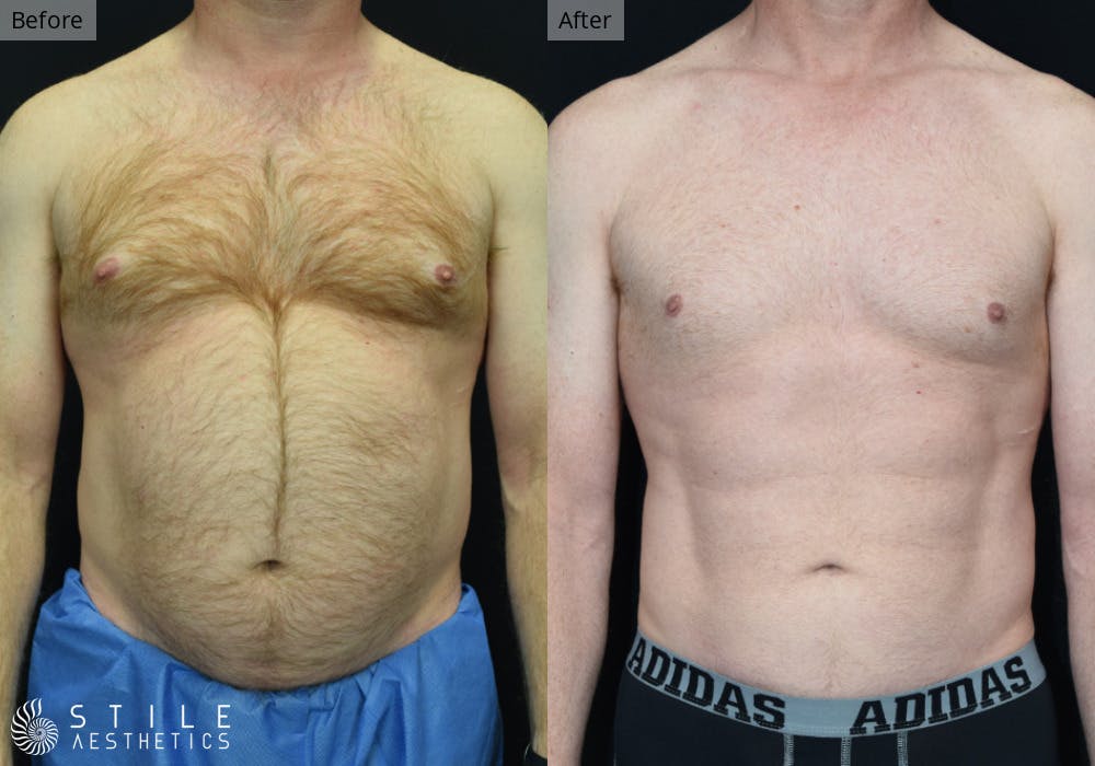 Liposuction Before & After Gallery - Patient 359958 - Image 1