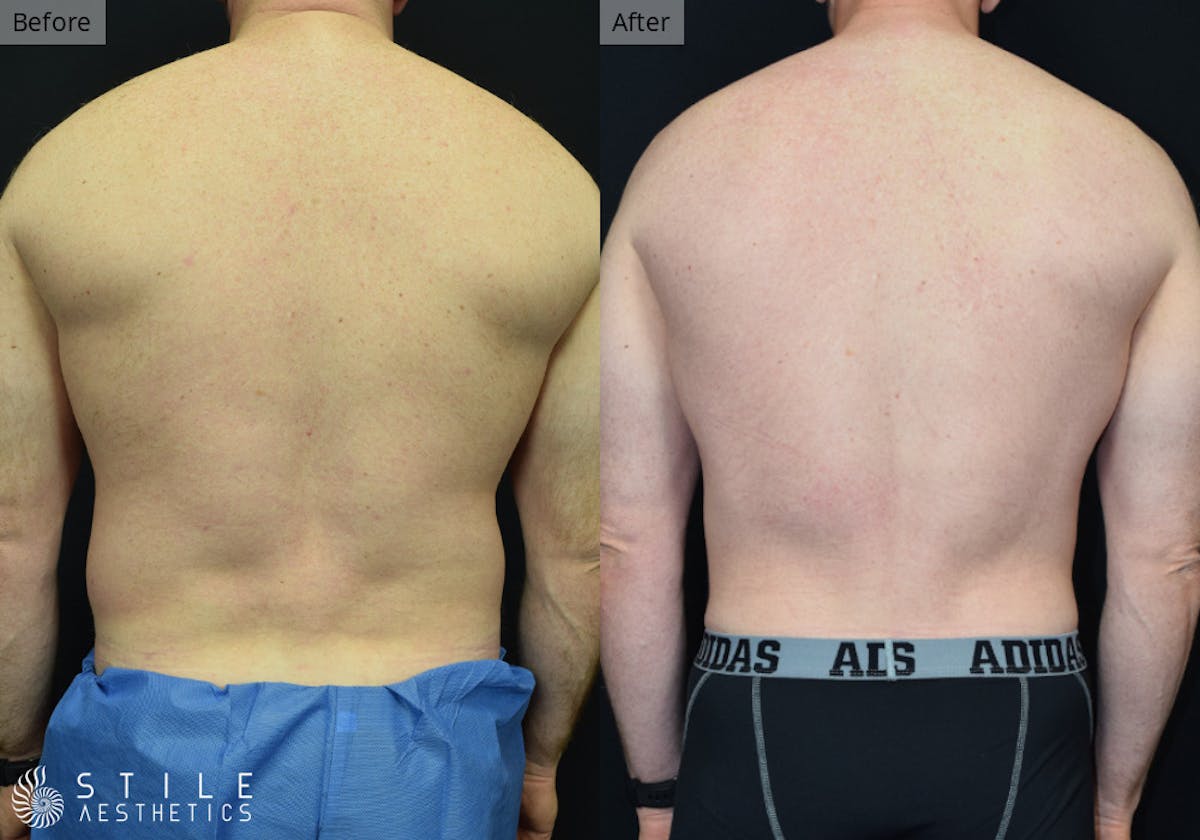 Liposuction Before & After Gallery - Patient 359958 - Image 2