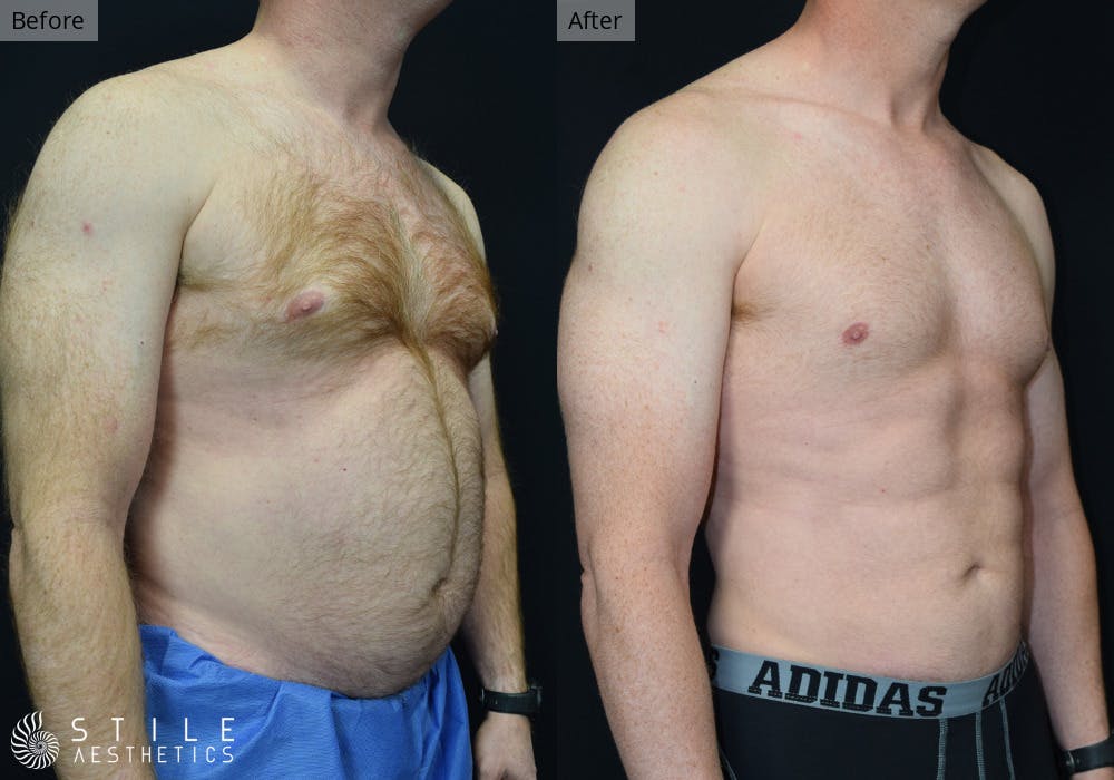 Liposuction Before & After Gallery - Patient 359958 - Image 3