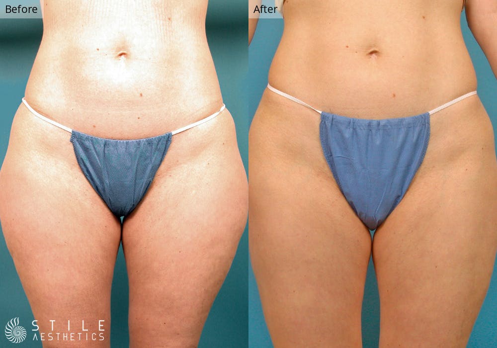 Liposuction Before & After Gallery - Patient 961055 - Image 1