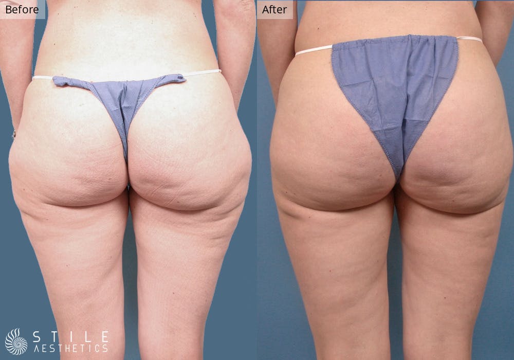 Liposuction Before & After Gallery - Patient 961055 - Image 2