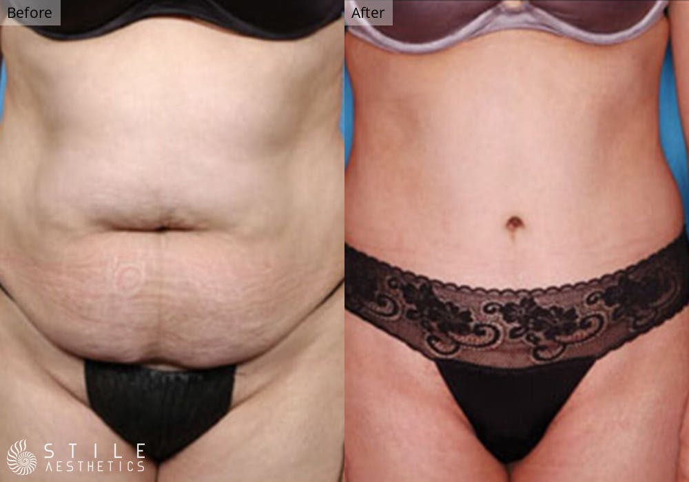 Liposuction Before & After Gallery - Patient 469985 - Image 1