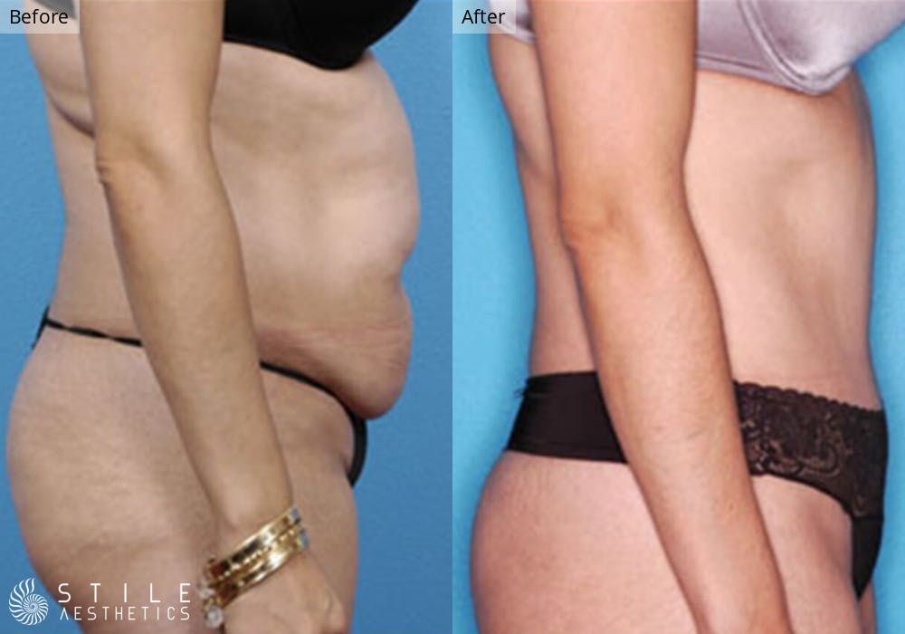 Liposuction Before & After Gallery - Patient 469985 - Image 2