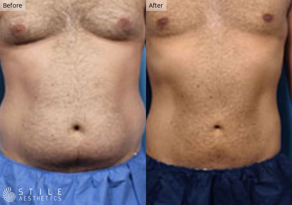 Liposuction Before & After Gallery - Patient 597301 - Image 1