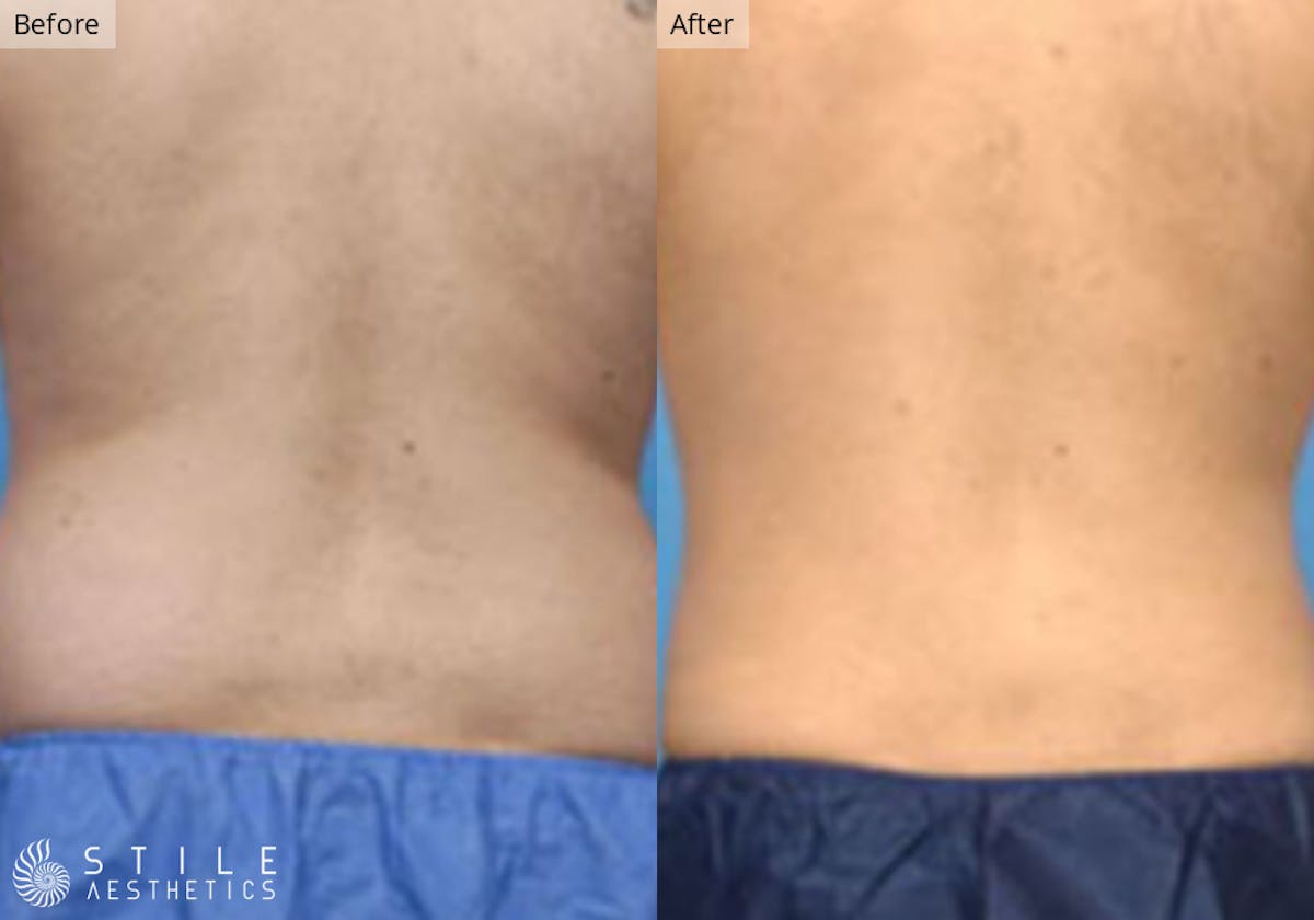Liposuction Before & After Gallery - Patient 597301 - Image 2