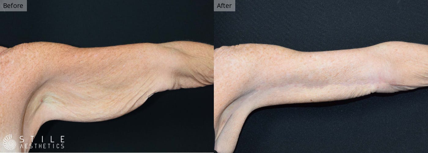Arm Lift Before & After Gallery - Patient 321714 - Image 1