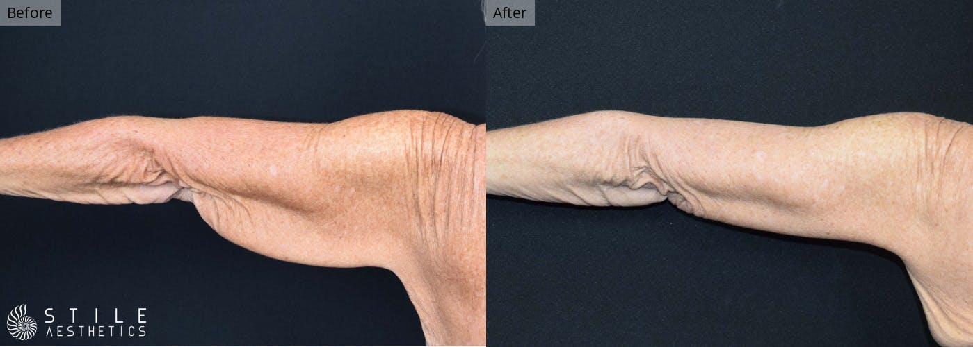 Arm Lift Before & After Gallery - Patient 321714 - Image 2