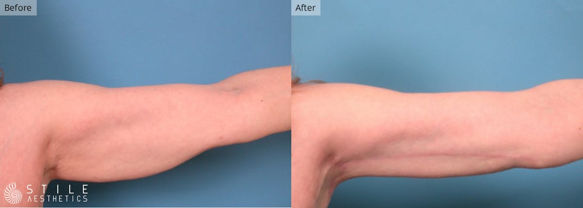 Arm Lift Before & After Gallery - Patient 124352 - Image 1