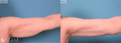 Arm Lift Before & After Gallery - Patient 124352 - Image 1