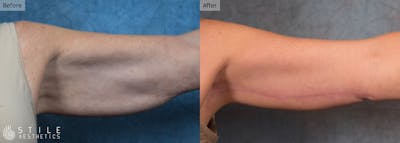 Arm Lift Before & After Gallery - Patient 365623 - Image 1