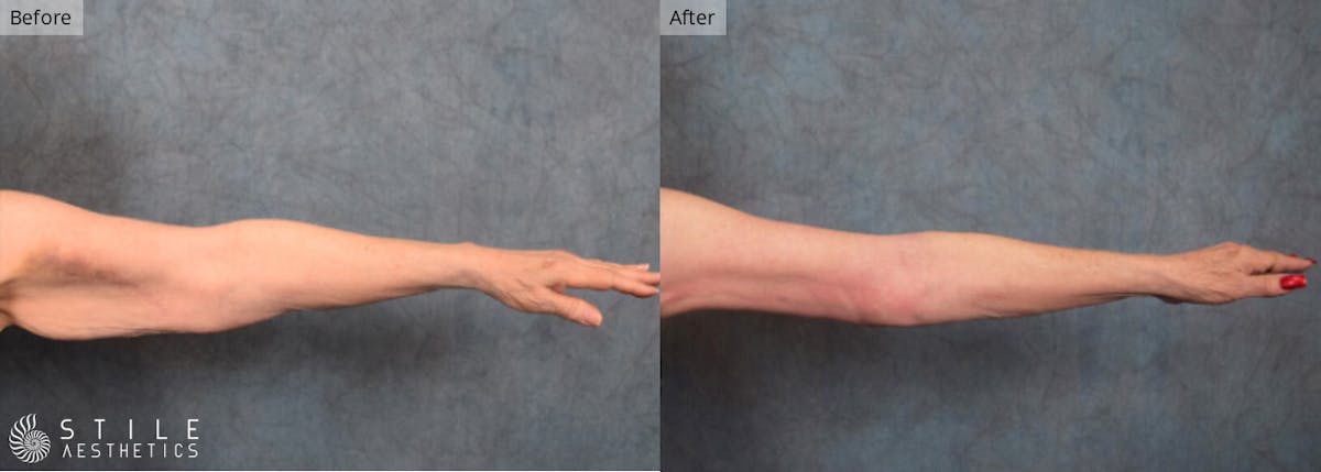Arm Lift Before & After Gallery - Patient 333026 - Image 1