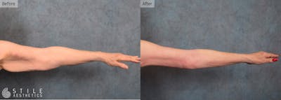 Arm Lift Before & After Gallery - Patient 333026 - Image 1