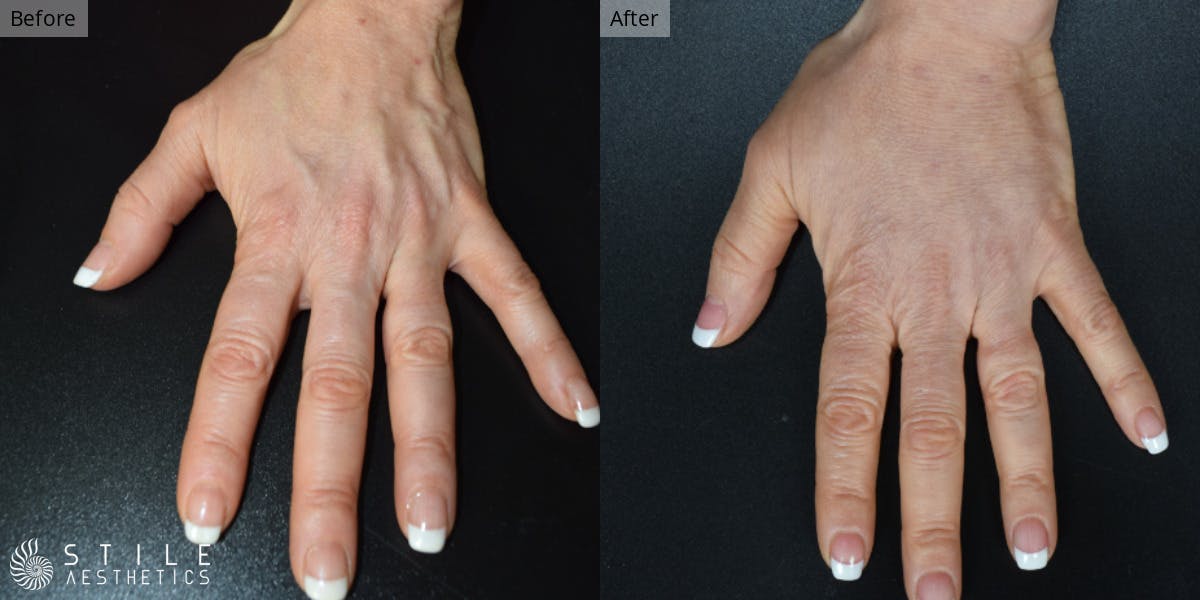 Fat Transfer Before & After Gallery - Patient 218139 - Image 1