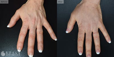 Fat Transfer Before & After Gallery - Patient 218139 - Image 1