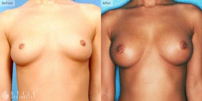 Breast Augmentation Before & After Gallery - Patient 368316 - Image 1