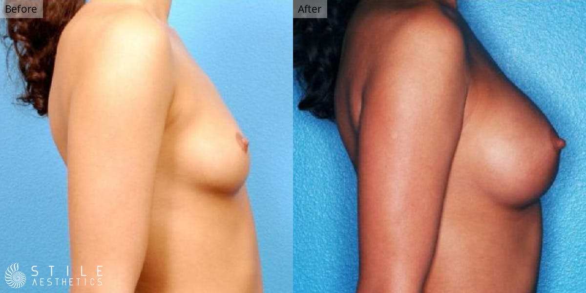 Breast Augmentation Before & After Gallery - Patient 368316 - Image 2