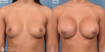 Breast Augmentation Before & After Gallery - Patient 474924 - Image 1