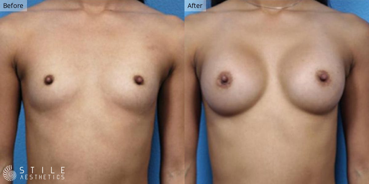 Breast Augmentation Before & After Gallery - Patient 147418 - Image 1