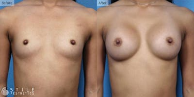 Breast Augmentation Before & After Gallery - Patient 147418 - Image 1