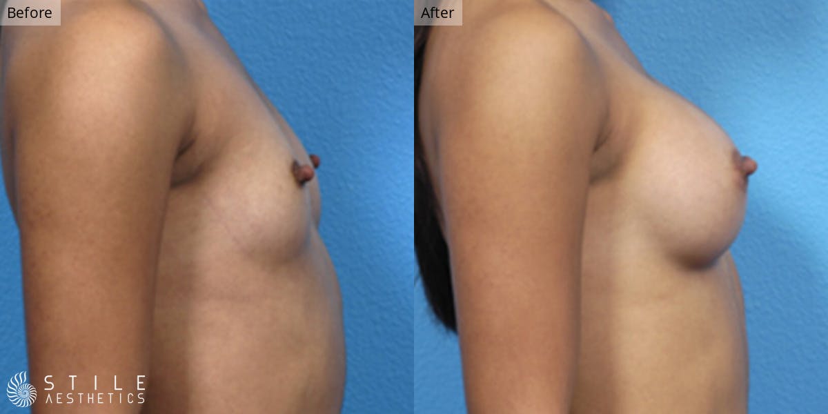 Breast Augmentation Before & After Gallery - Patient 147418 - Image 2