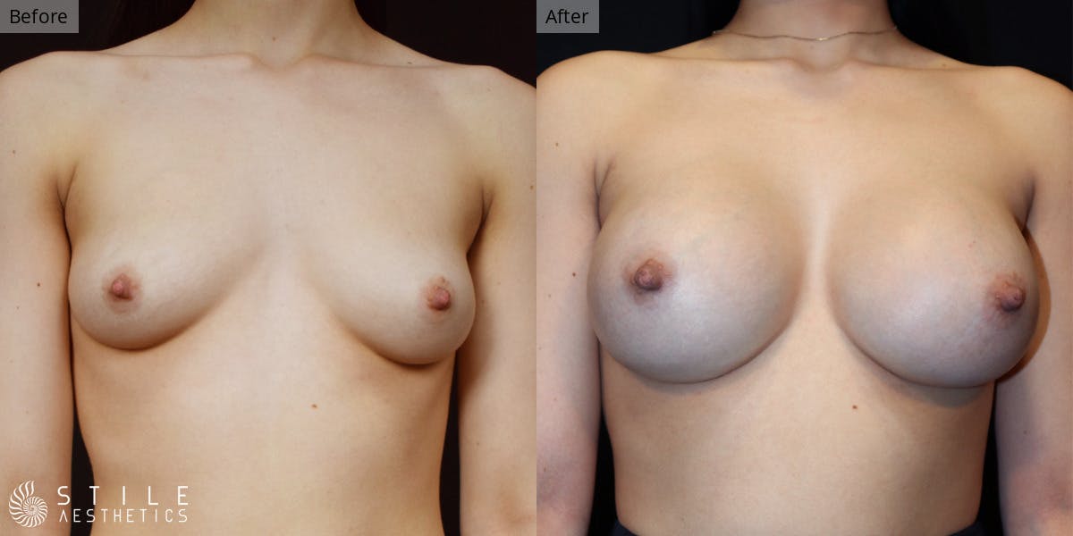 Breast Augmentation Before & After Gallery - Patient 672698 - Image 1