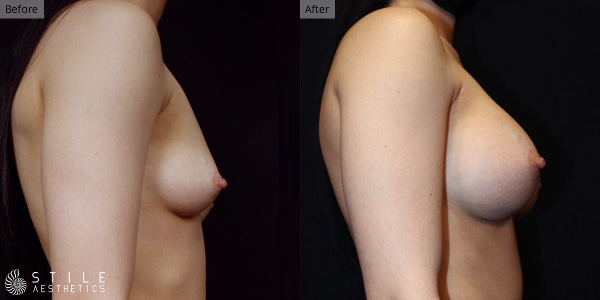 Breast Augmentation Before & After Gallery - Patient 672698 - Image 2