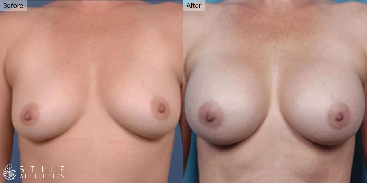 Breast Augmentation Before & After Gallery - Patient 928468 - Image 1