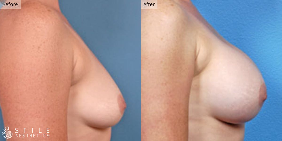 Breast Augmentation Before & After Gallery - Patient 928468 - Image 2