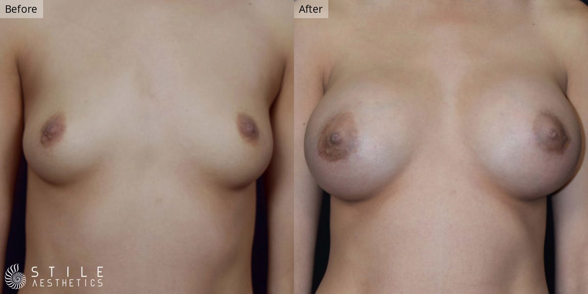 Breast Augmentation Before & After Gallery - Patient 330153 - Image 1