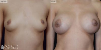 Breast Augmentation Before & After Gallery - Patient 330153 - Image 1