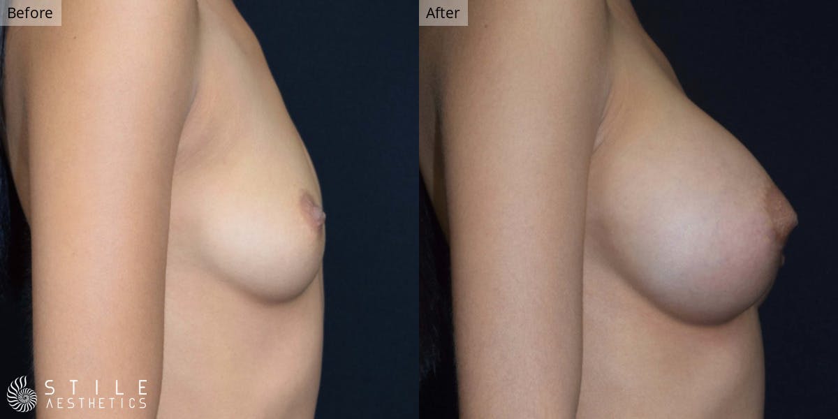 Breast Augmentation Before & After Gallery - Patient 330153 - Image 2