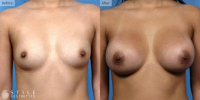 Breast Augmentation Before & After Gallery - Patient 306096 - Image 1