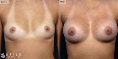 Breast Augmentation Before & After Gallery - Patient 251349 - Image 1