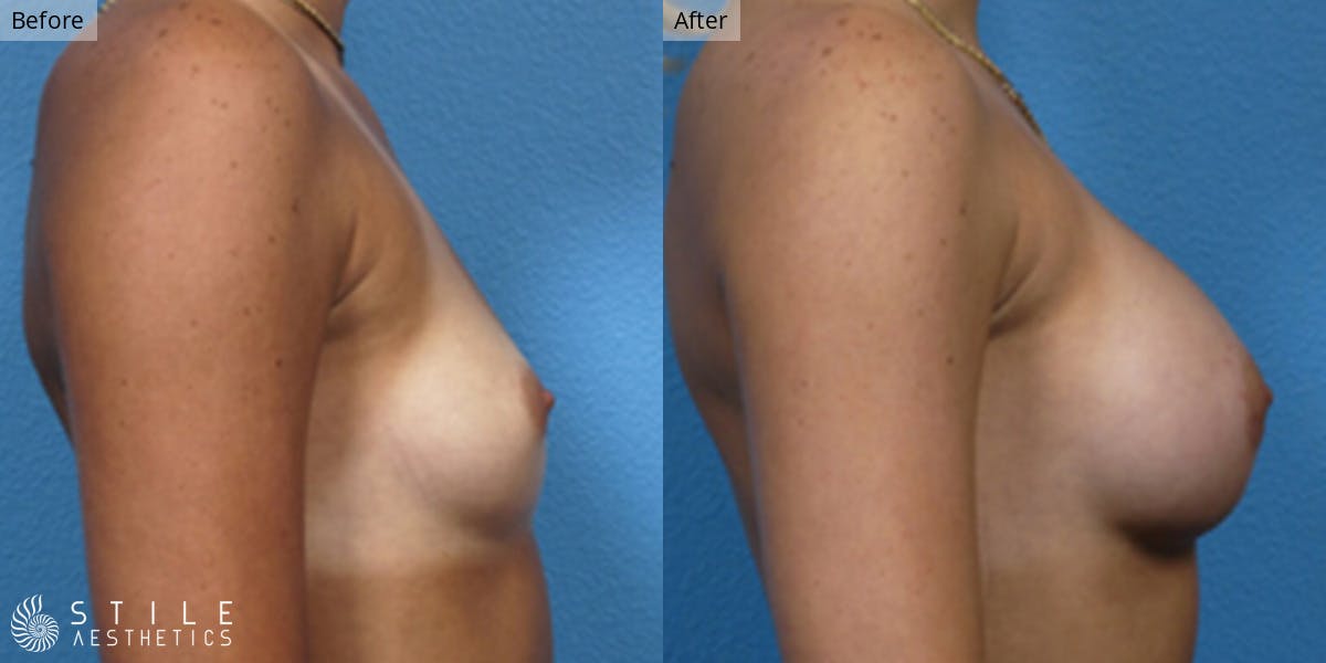 Breast Augmentation Before & After Gallery - Patient 251349 - Image 2