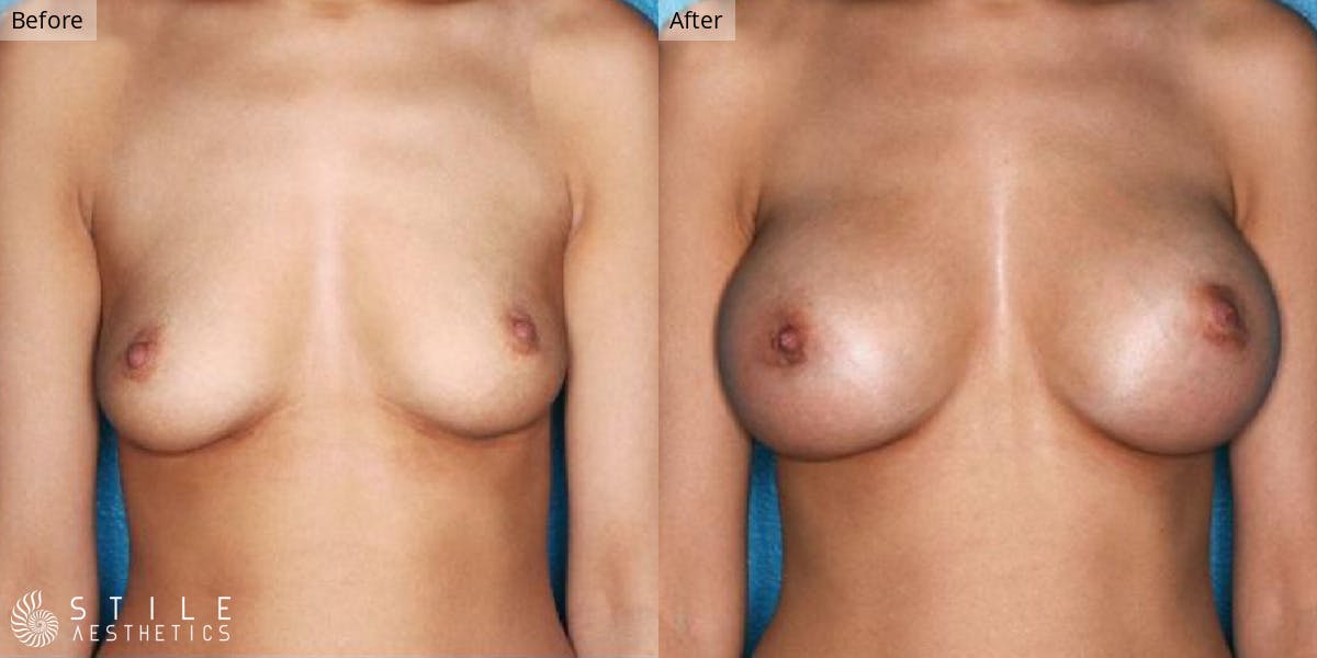Breast Augmentation Before & After Gallery - Patient 334262 - Image 1