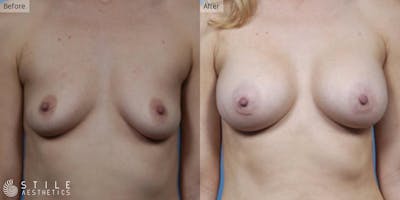 Breast Augmentation Before & After Gallery - Patient 552567 - Image 1