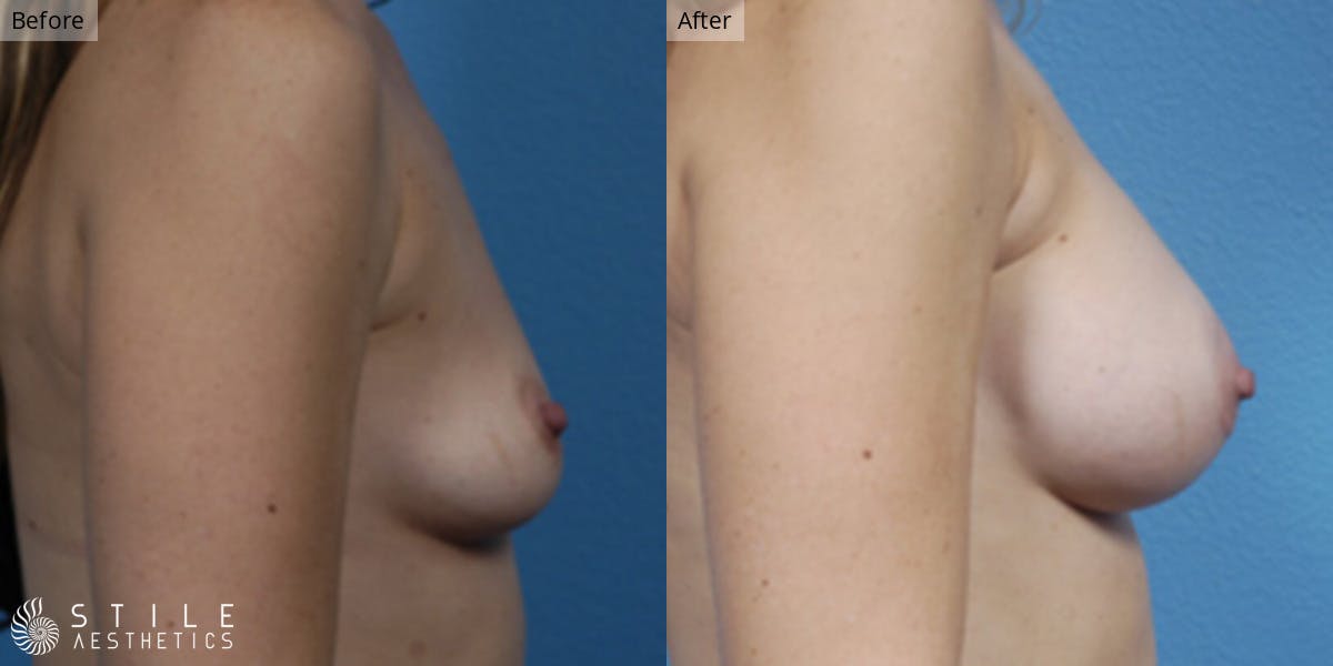 Breast Augmentation Before & After Gallery - Patient 552567 - Image 2