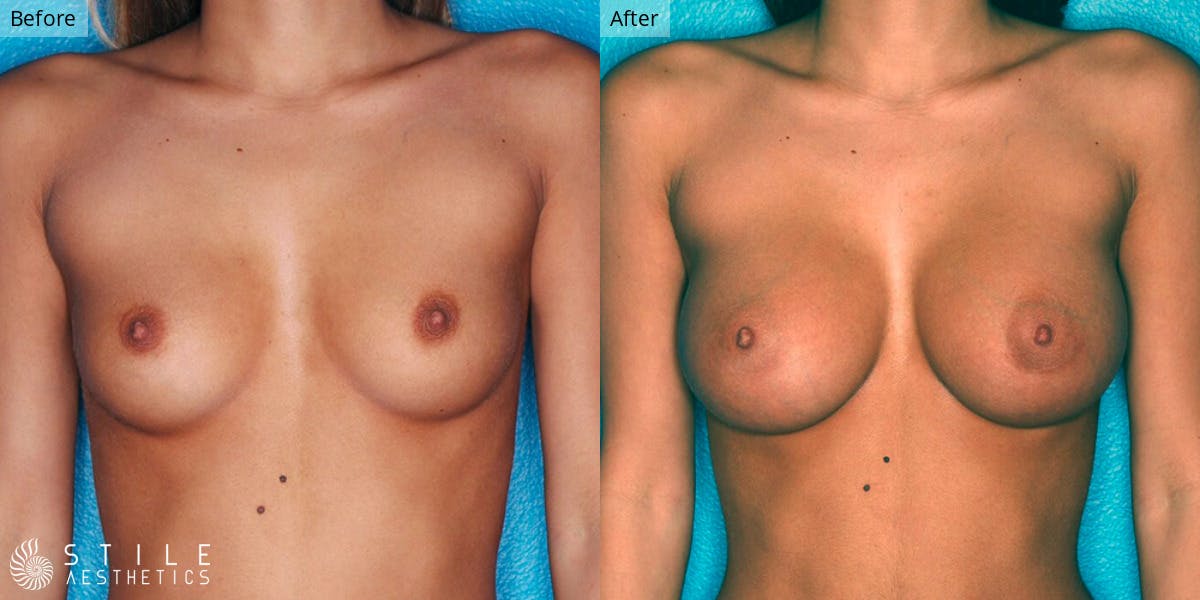 Breast Augmentation Before & After Gallery - Patient 147874 - Image 1