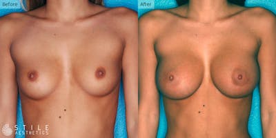 Breast Augmentation Before & After Gallery - Patient 147874 - Image 1