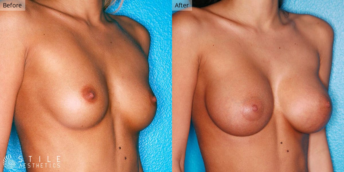 Breast Augmentation Before & After Gallery - Patient 147874 - Image 2