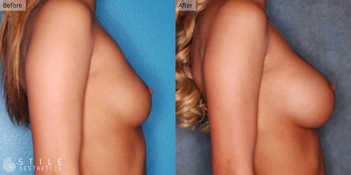 Breast Augmentation Before & After Gallery - Patient 197672 - Image 2