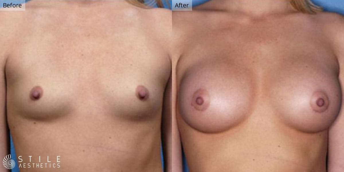 Breast Augmentation Before & After Gallery - Patient 160516 - Image 1