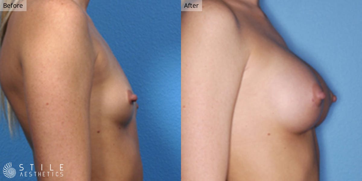 Breast Augmentation Before & After Gallery - Patient 160516 - Image 2