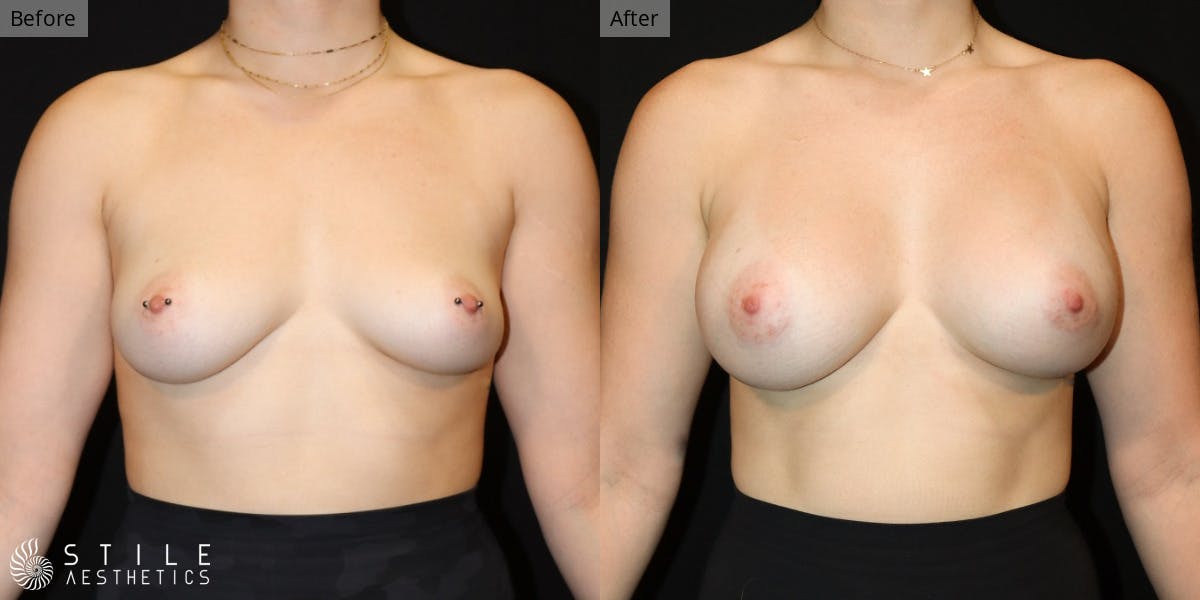 Breast Augmentation Before & After Gallery - Patient 123044 - Image 1