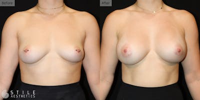 Breast Augmentation Before & After Gallery - Patient 123044 - Image 1
