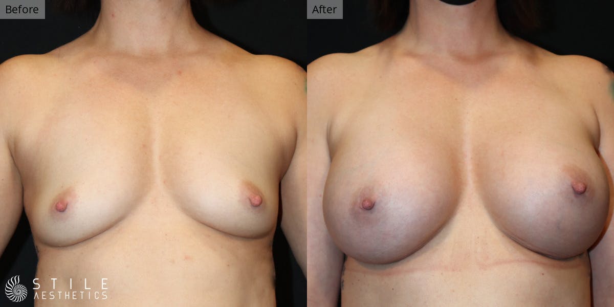 Breast Augmentation Before & After Gallery - Patient 314597 - Image 1