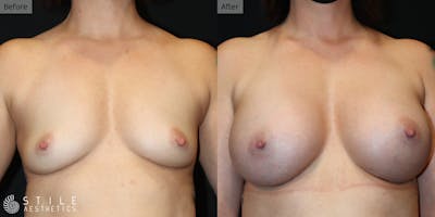 Breast Augmentation Before & After Gallery - Patient 314597 - Image 1